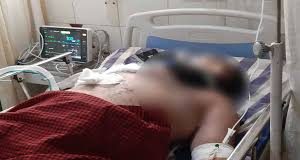 प्रेमिका पर तेजाब फेंक जिंदा जलाने की कोशिश की