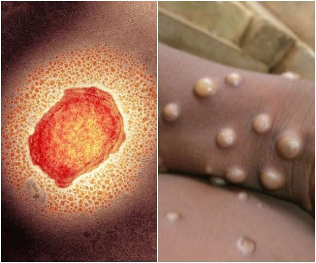 monkey pox